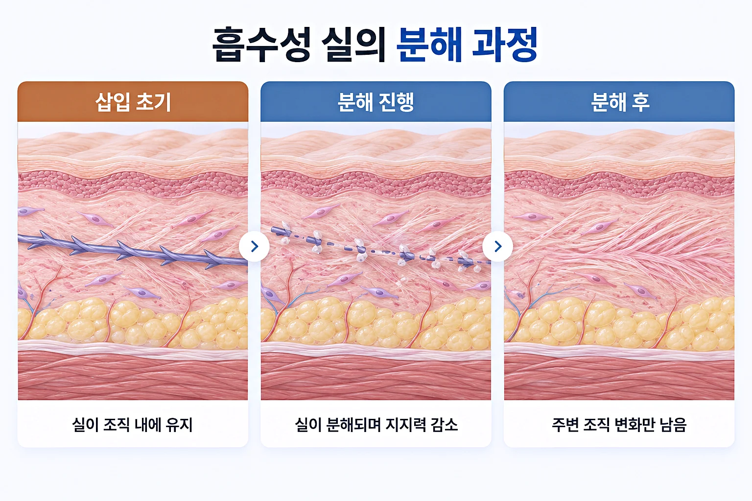 흡수성 실의 분해 과정 - 삽입 초기부터 분해 후까지