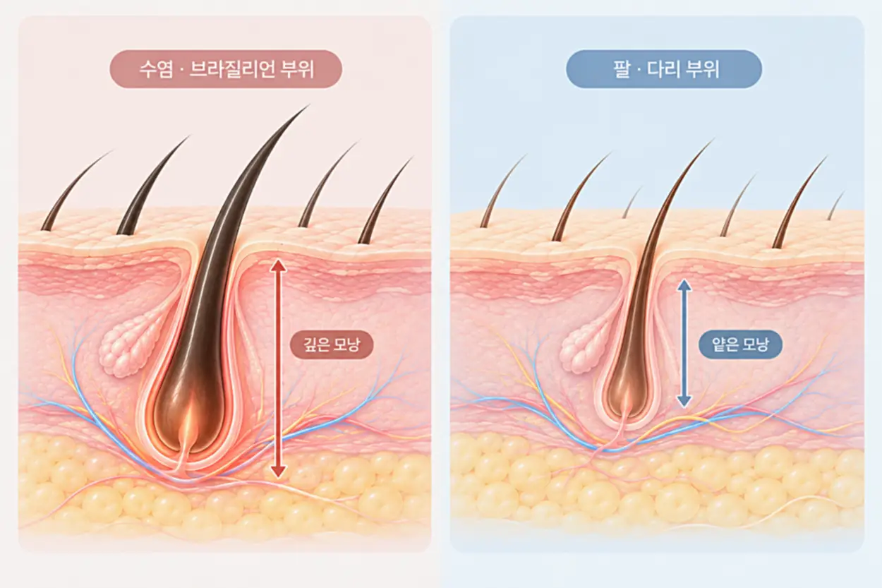 수염 브라질리언 부위와 팔 다리 부위의 모낭 차이점을 나타내는 이미지