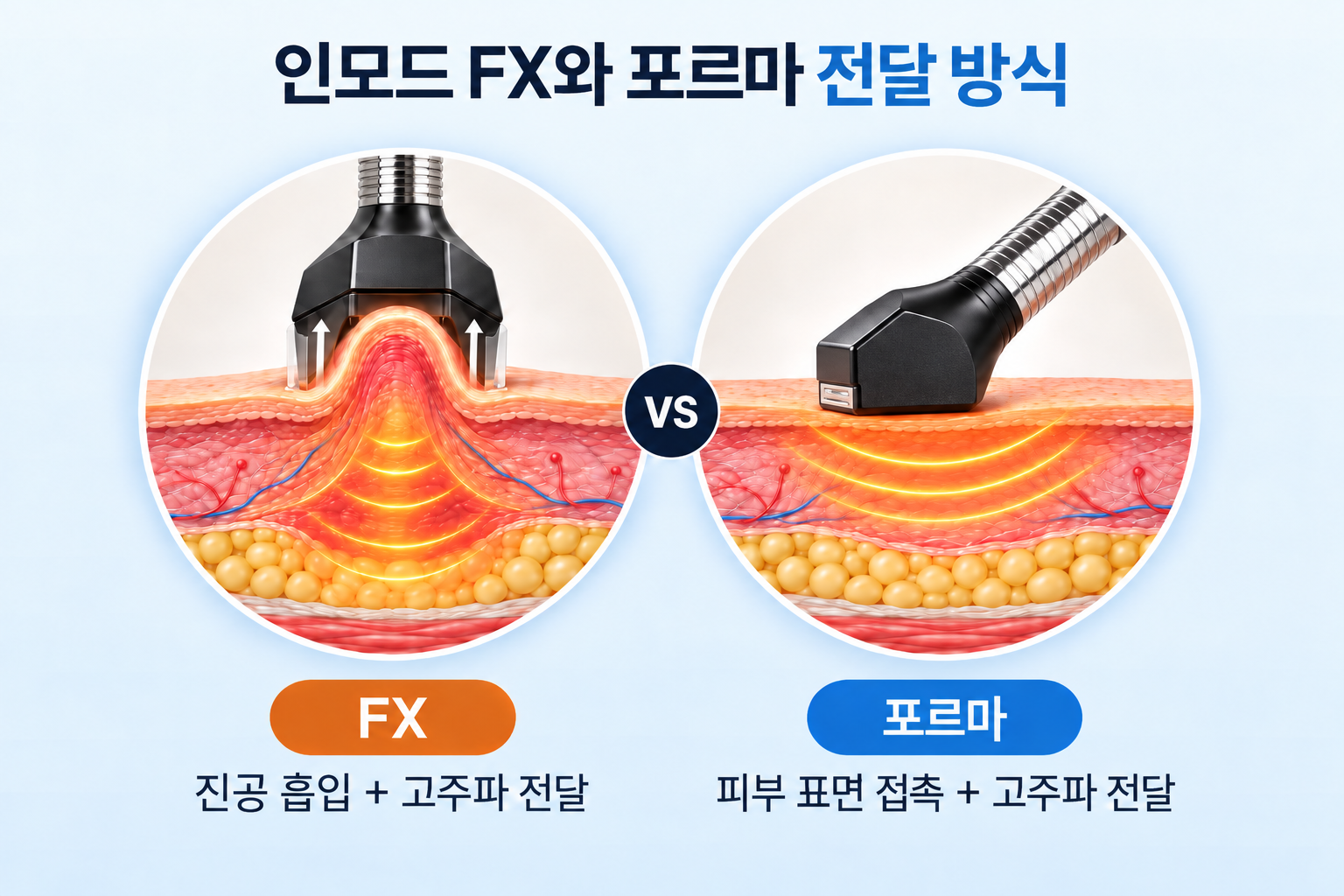 인모드 FX의 진공 흡입에 따른 피부와 지방층의 변화 및 포르마의 피부 표면 접촉식 고주파 열 전달 구조