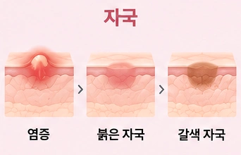 염증성 여드름이 가라앉은 뒤 붉은 자국을 거쳐 갈색 색소침착으로 남는 과정을 단계별로 나타낸 피부 단면 모식도