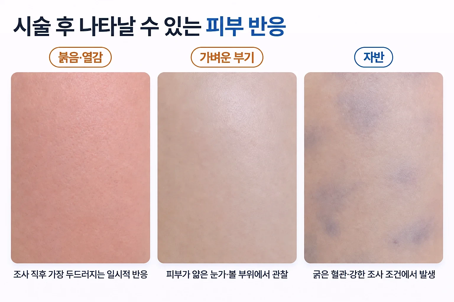 시술 후 붉음과 열감, 가벼운 부기, 자반 반응을 같은 배율로 비교한 피부 표면 일러스트