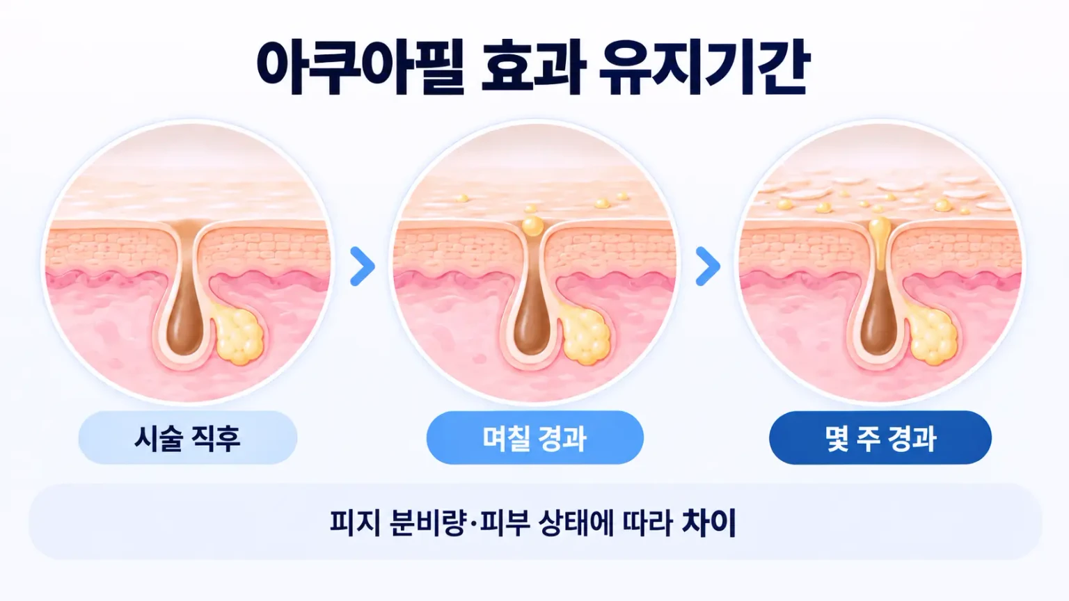 아쿠아필 효과 유지기간과 피부 상태에 따른 개인차를 설명한 피부과 교육용 인포그래픽