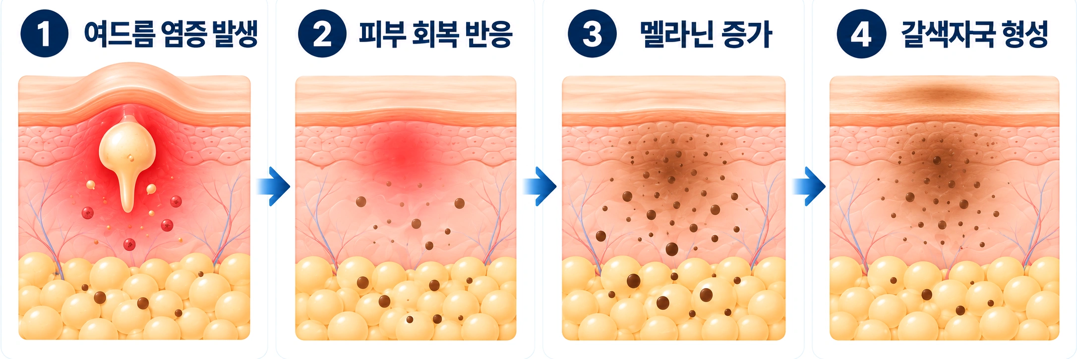 여드름 염증 후 멜라닌이 증가해 갈색자국으로 남는 과정