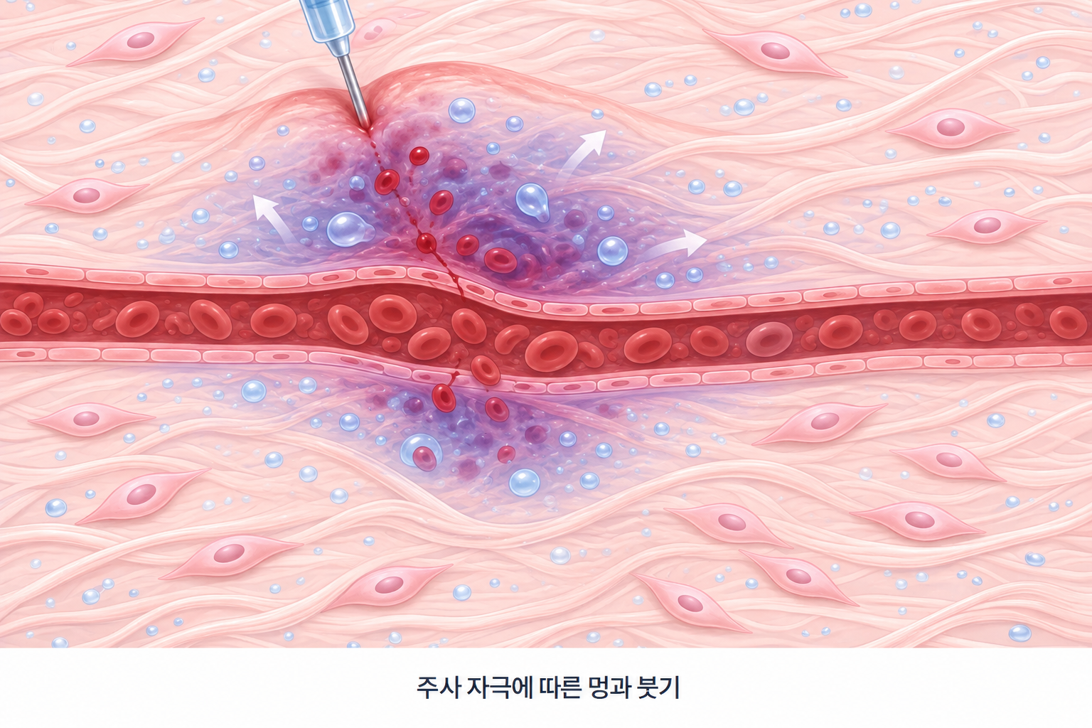 스킨부스터 주사 바늘이 미세혈관을 자극해 주변 피부 조직에 혈액과 체액이 퍼지면서 멍과 붓기가 발생하는 단면 구조