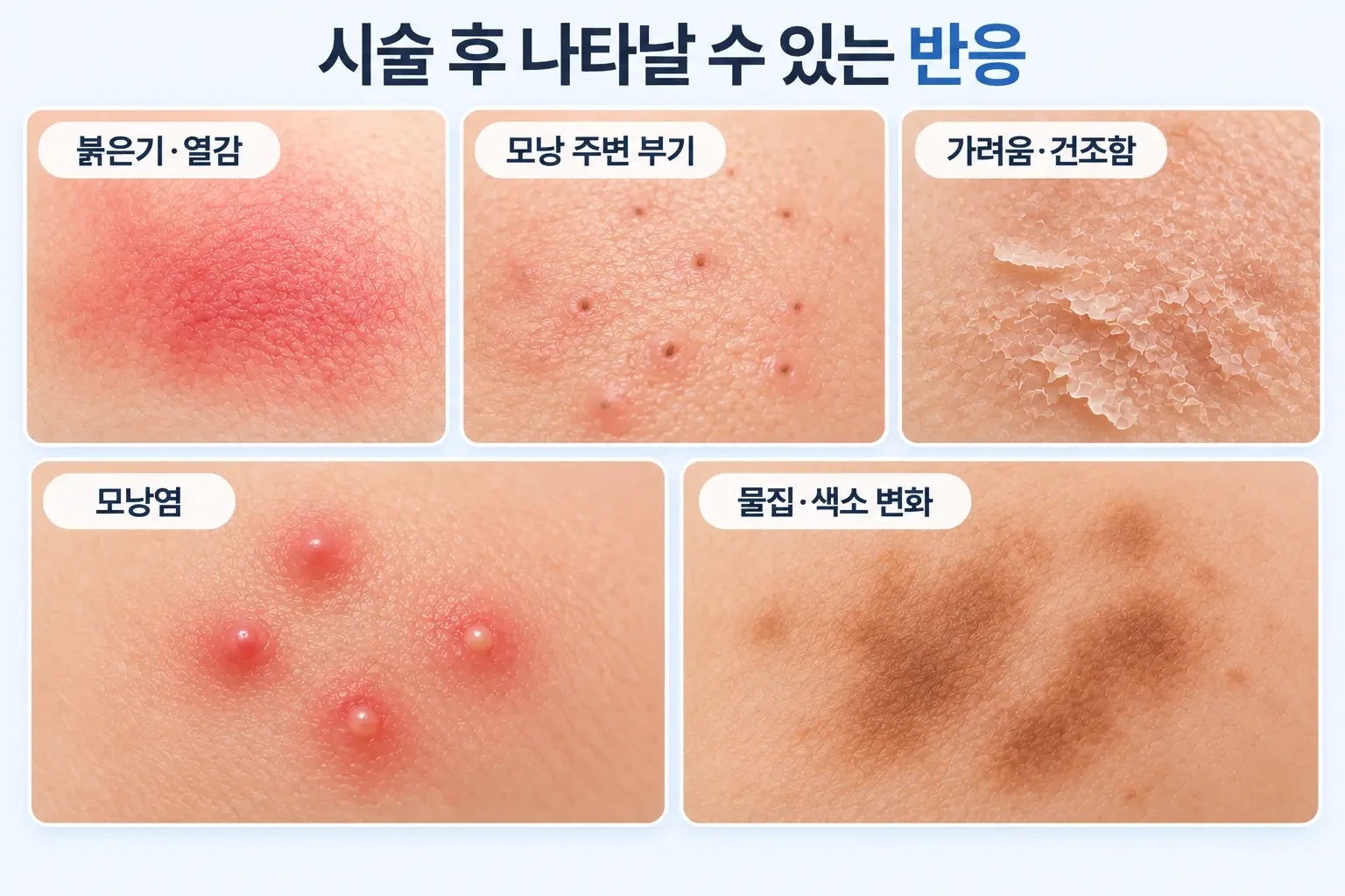 레이저 제모 후 붉은기, 모낭 주변 부기, 건조함, 모낭염 등 반응별 관리를 정리한 카드 이미지