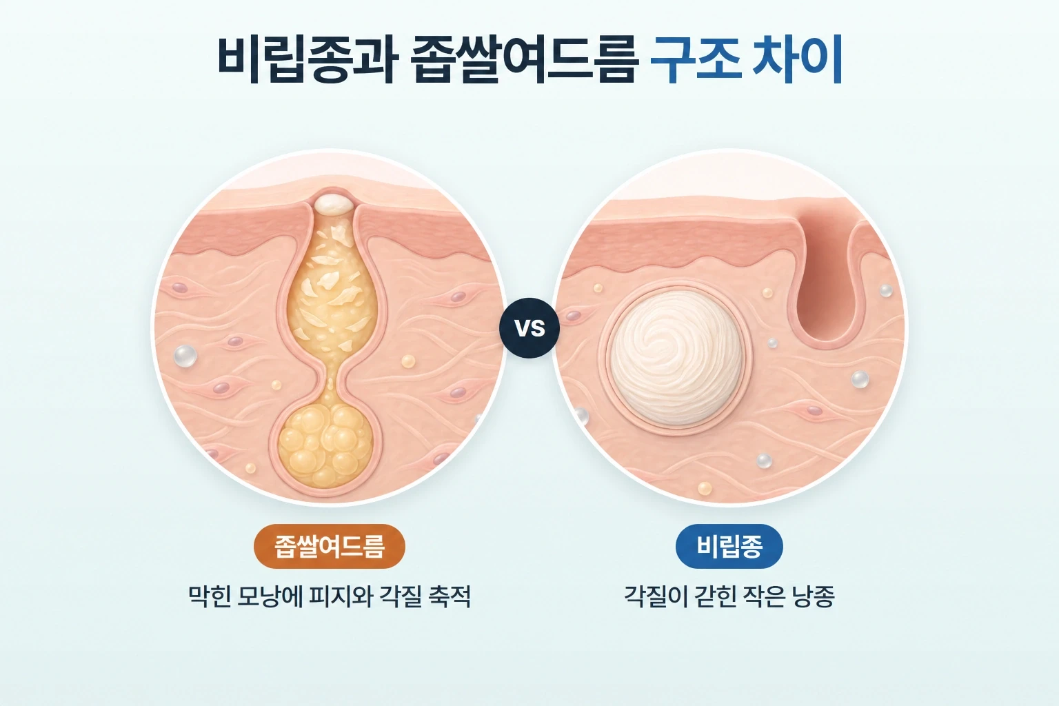 좁쌀여드름은 막힌 모낭에 피지와 각질이 축적되고 비립종은 피부 속 작은 낭종에 각질이 갇혀 형성되는 구조적 차이