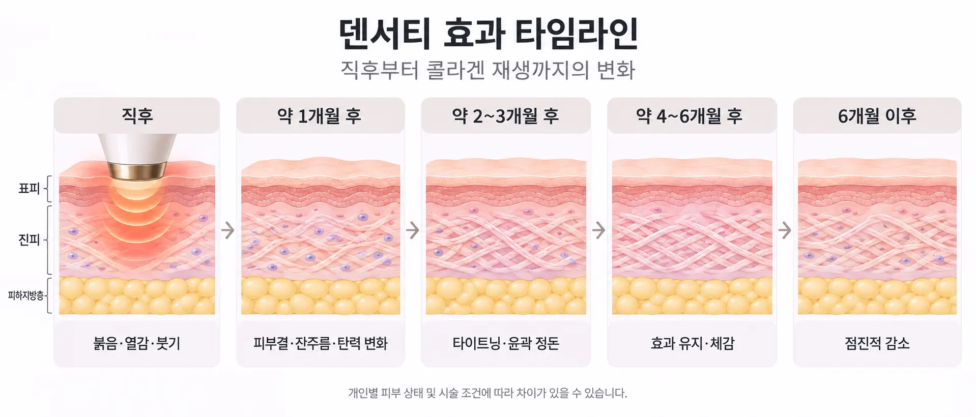 덴서티 효과 시술 직후부터 콜라겐 재생까지 시간 흐름