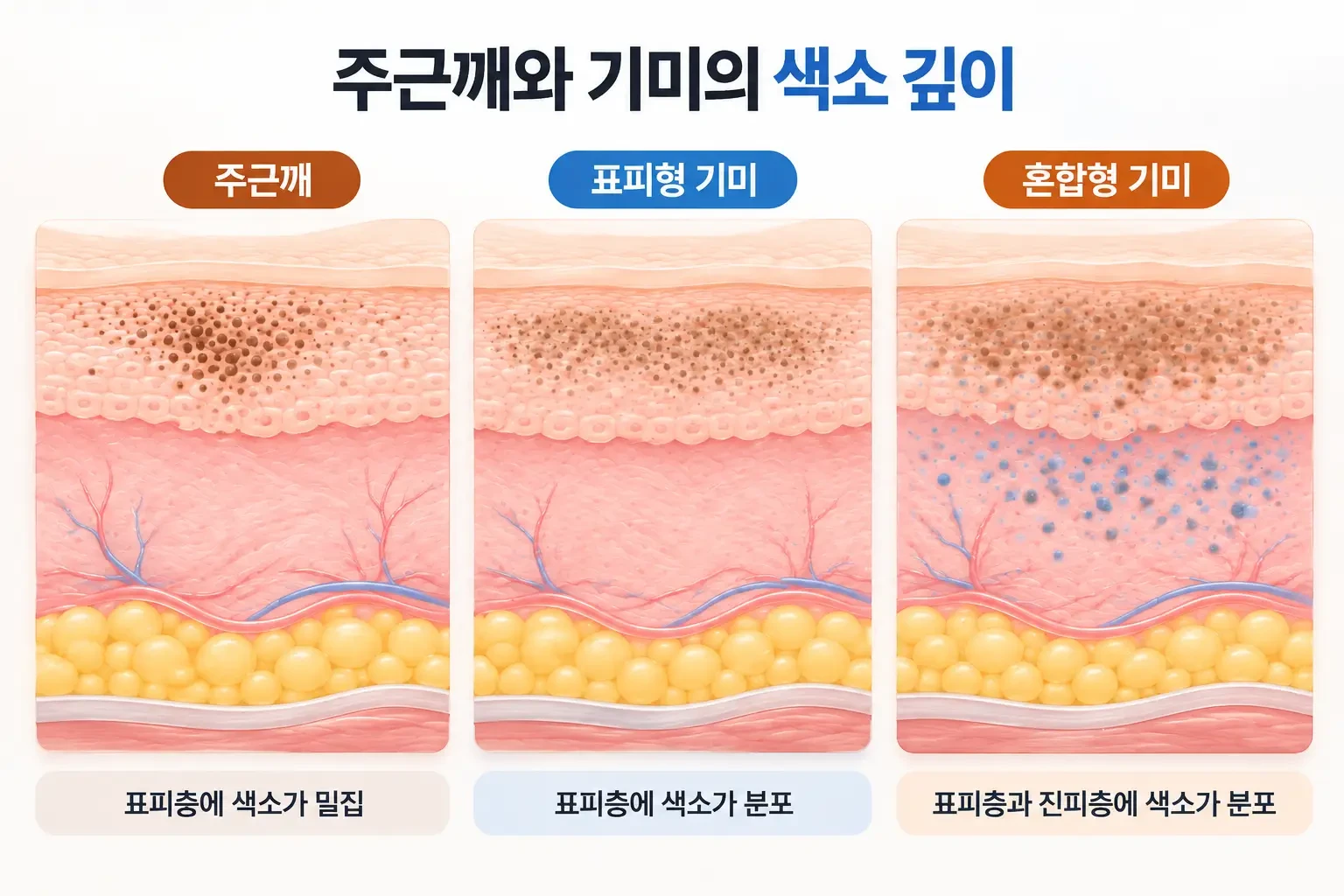 표피 아래쪽 주근깨 색소와 표피·진피에 걸친 기미 색소의 깊이를 층별로 비교한 피부 단면 모식도