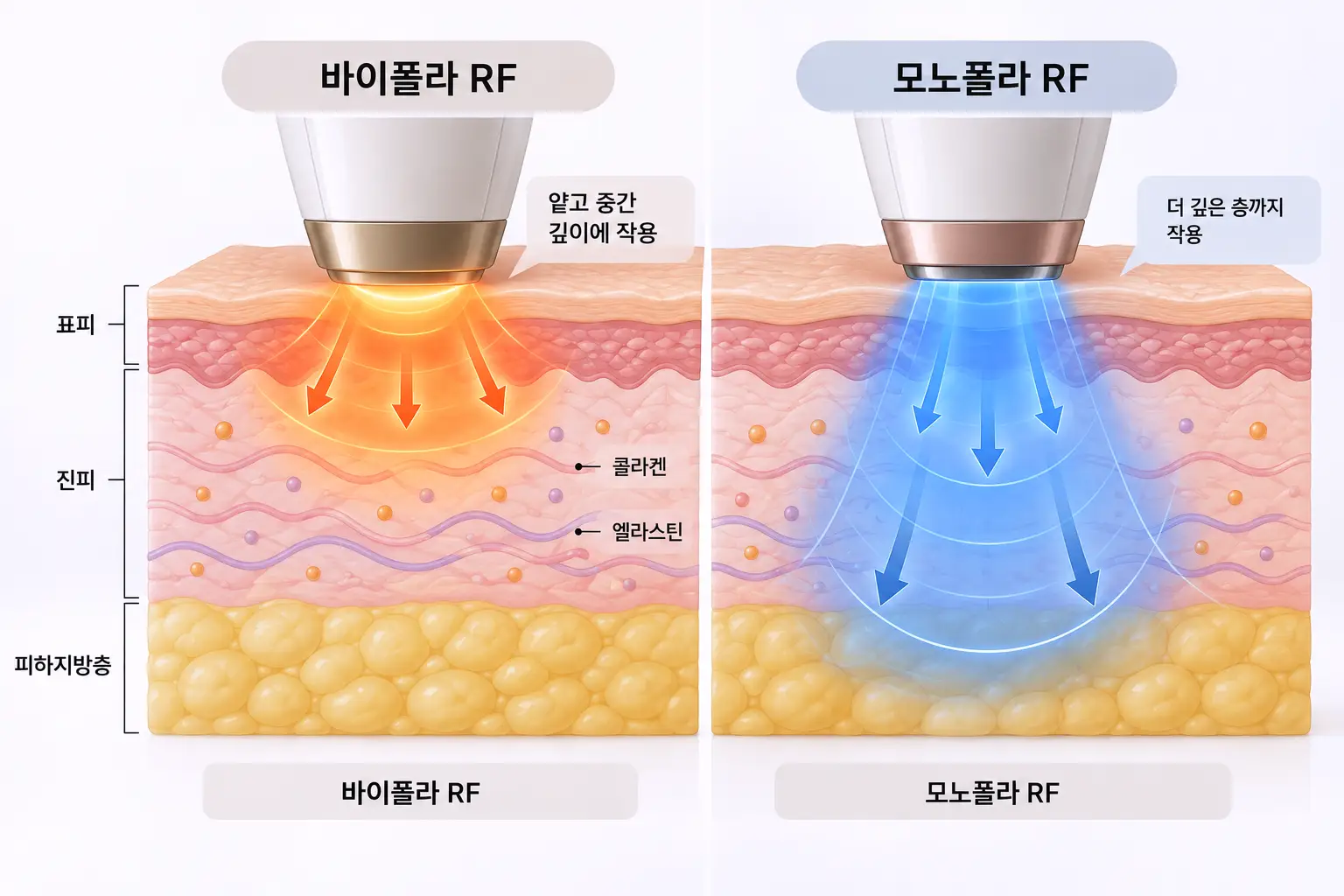 덴서티 모노폴라 바이폴라 고주파 작용 깊이 비교 단면도