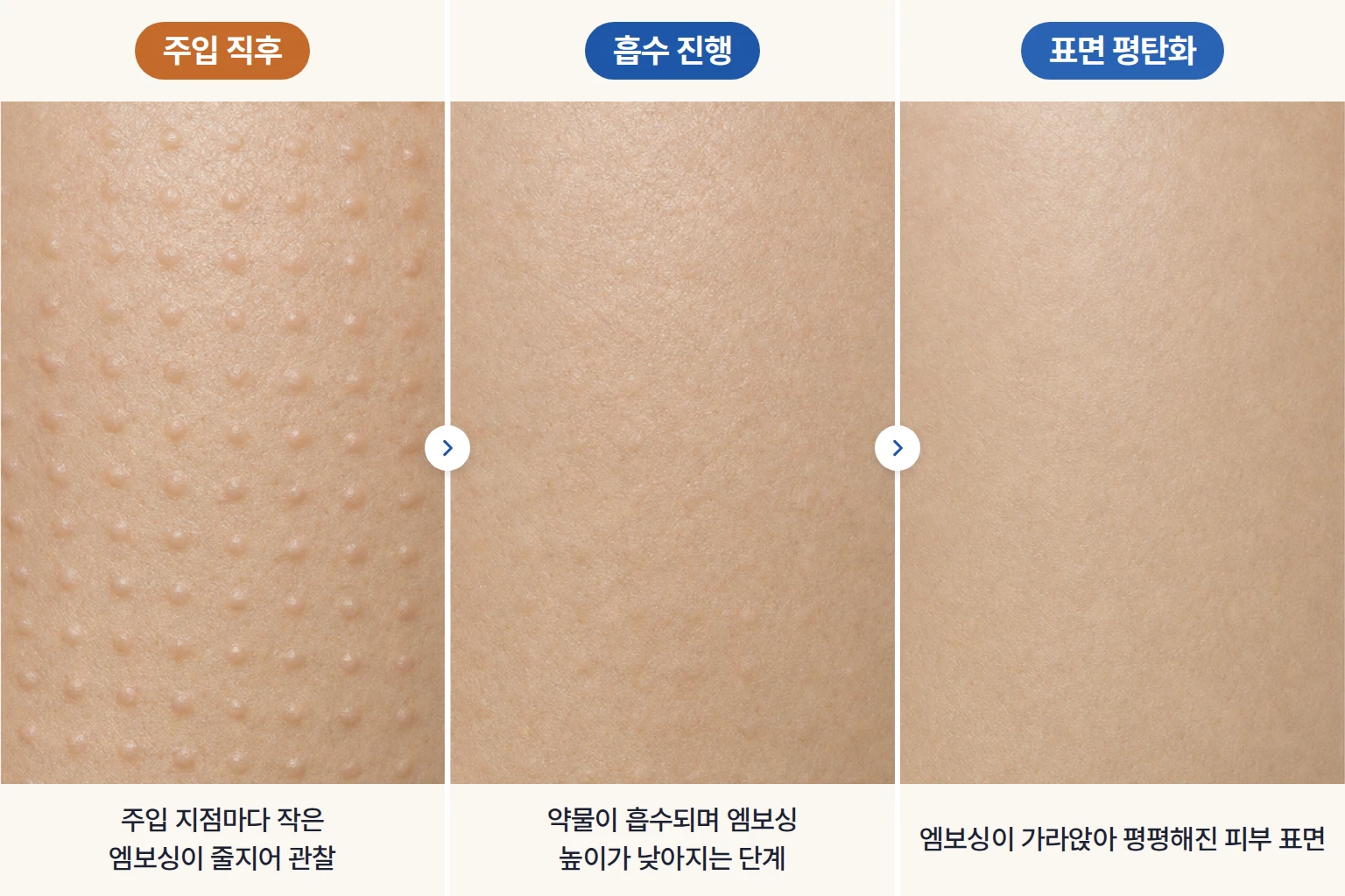주입 지점마다 솟은 작은 엠보싱이 흡수되며 평평해지는 과정을 단계별로 보여준 피부 표면 비교 사진