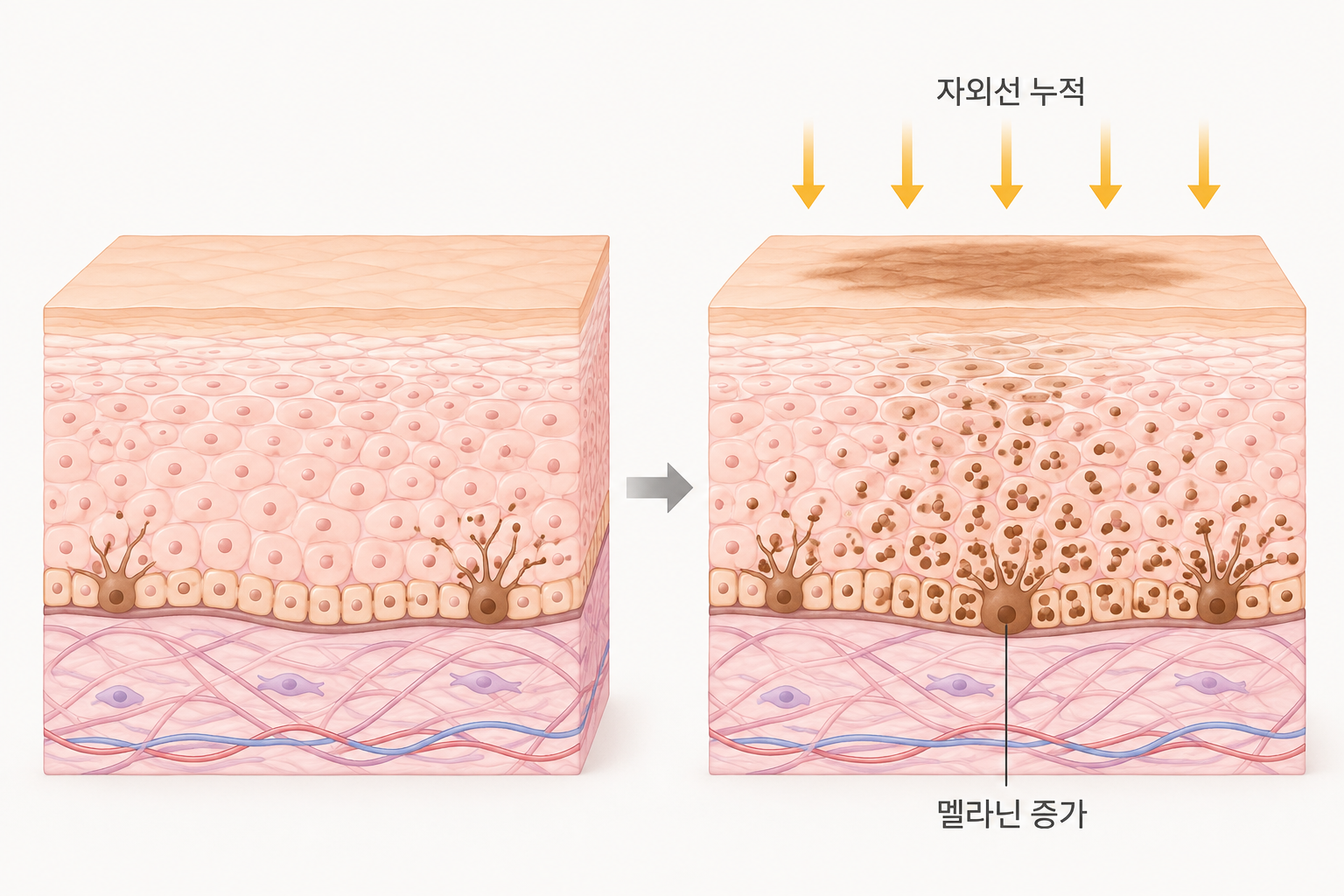 자외선 노출이 누적되면서 표피 기저층의 멜라닌 색소가 증가하는 흑자 발생 과정
