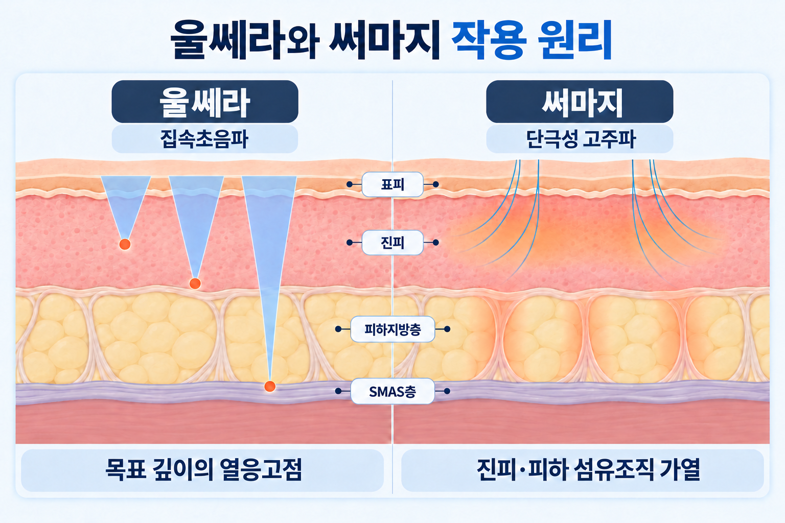 울쎄라의 집속초음파와 써마지의 단극성 고주파가 피부 조직에 작용하는 원리를 비교한 단면도