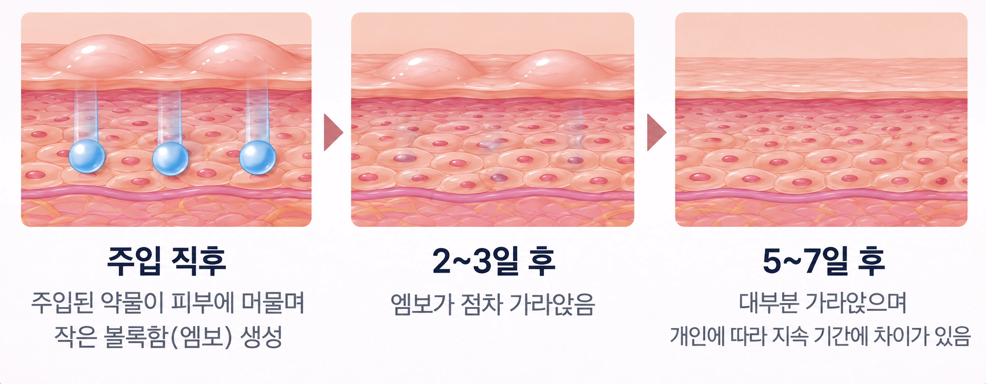 아이 리쥬란 시술 후 엠보가 가라앉는 과정