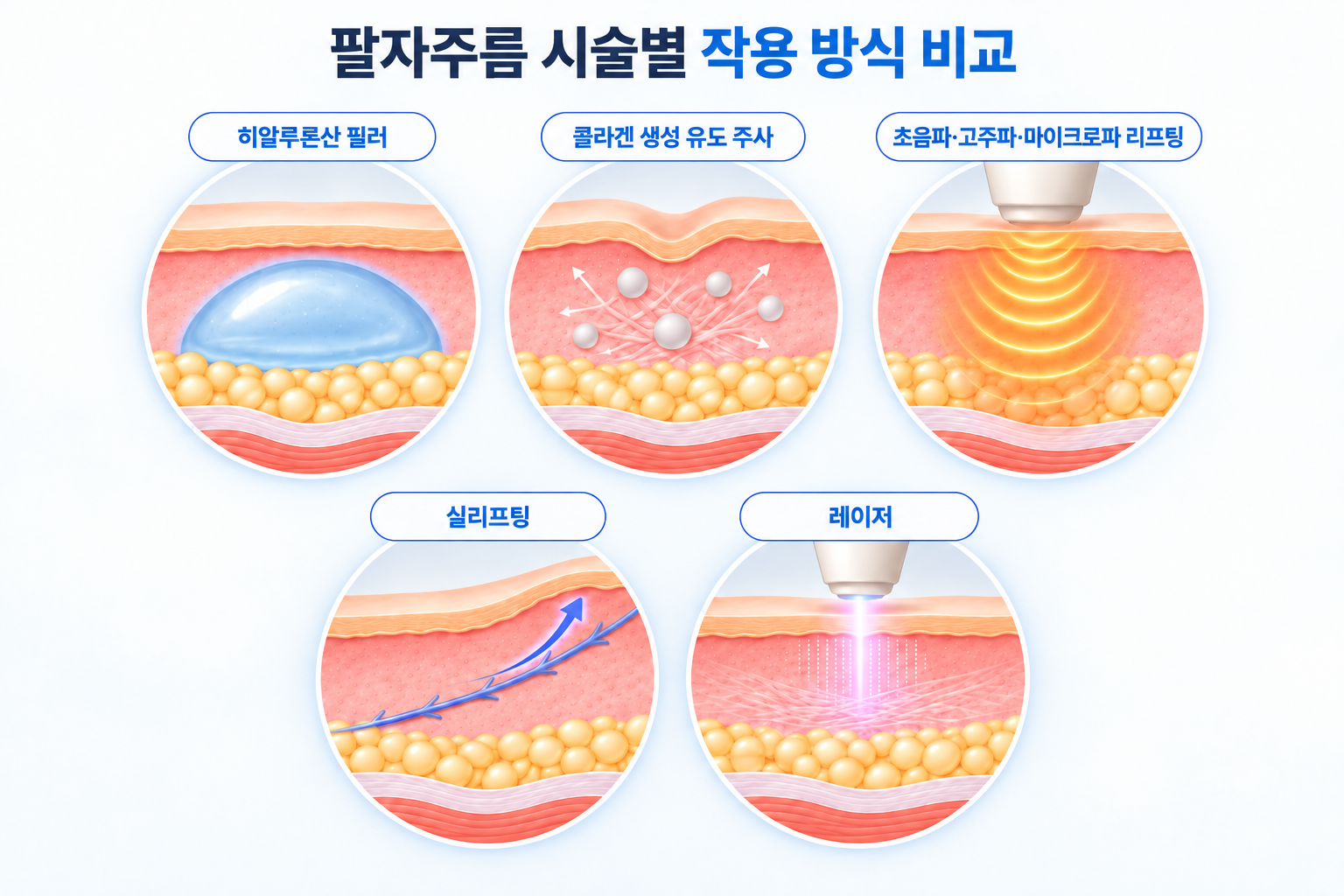 히알루론산 필러, 콜라겐 생성 유도 주사, 에너지 리프팅, 실리프팅, 레이저의 피부 조직별 작용 방식