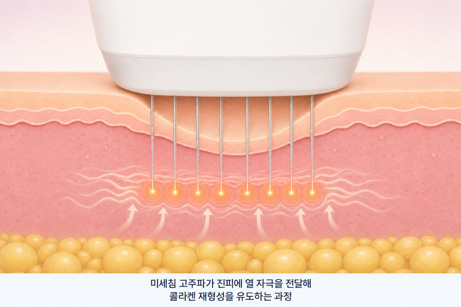 시크릿레이저와 미세침 방식 포텐자에 적용되는 고주파 원리로, 미세침 끝에서 진피에 열에너지를 전달해 콜라겐 재형성을 유도하는 구조