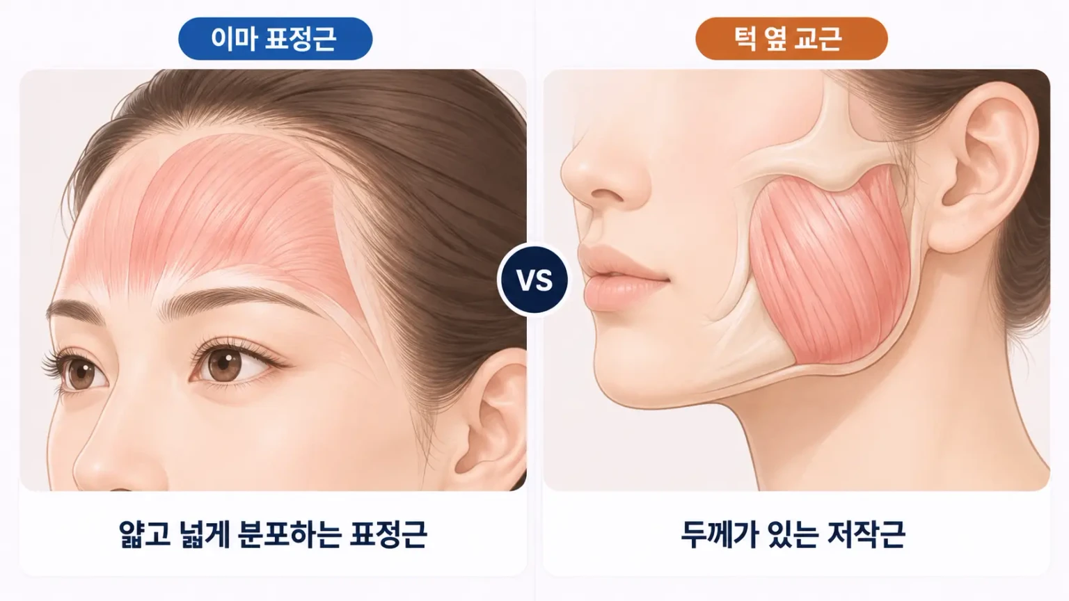 이마의 얇은 표정근과 턱 옆 두꺼운 교근의 두께와 주입 깊이를 비교한 단면 일러스트