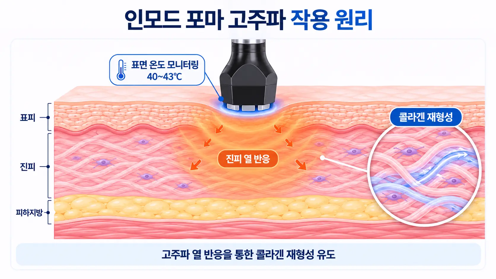 인모드 포마 고주파의 진피층 열 반응과 콜라겐 재형성 원리를 보여주는 피부 단면 의료 일러스트