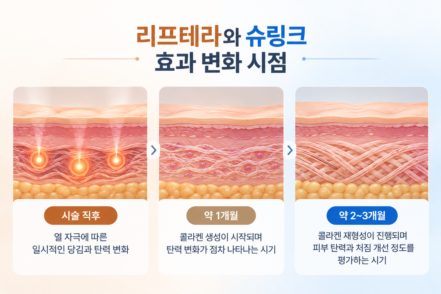 리프테라와 슈링크의 초음파 리프팅 직후 열 자극, 약 1개월의 콜라겐 변화, 약 2~3개월의 조직 재형성을 비교한 피부 단면 구조