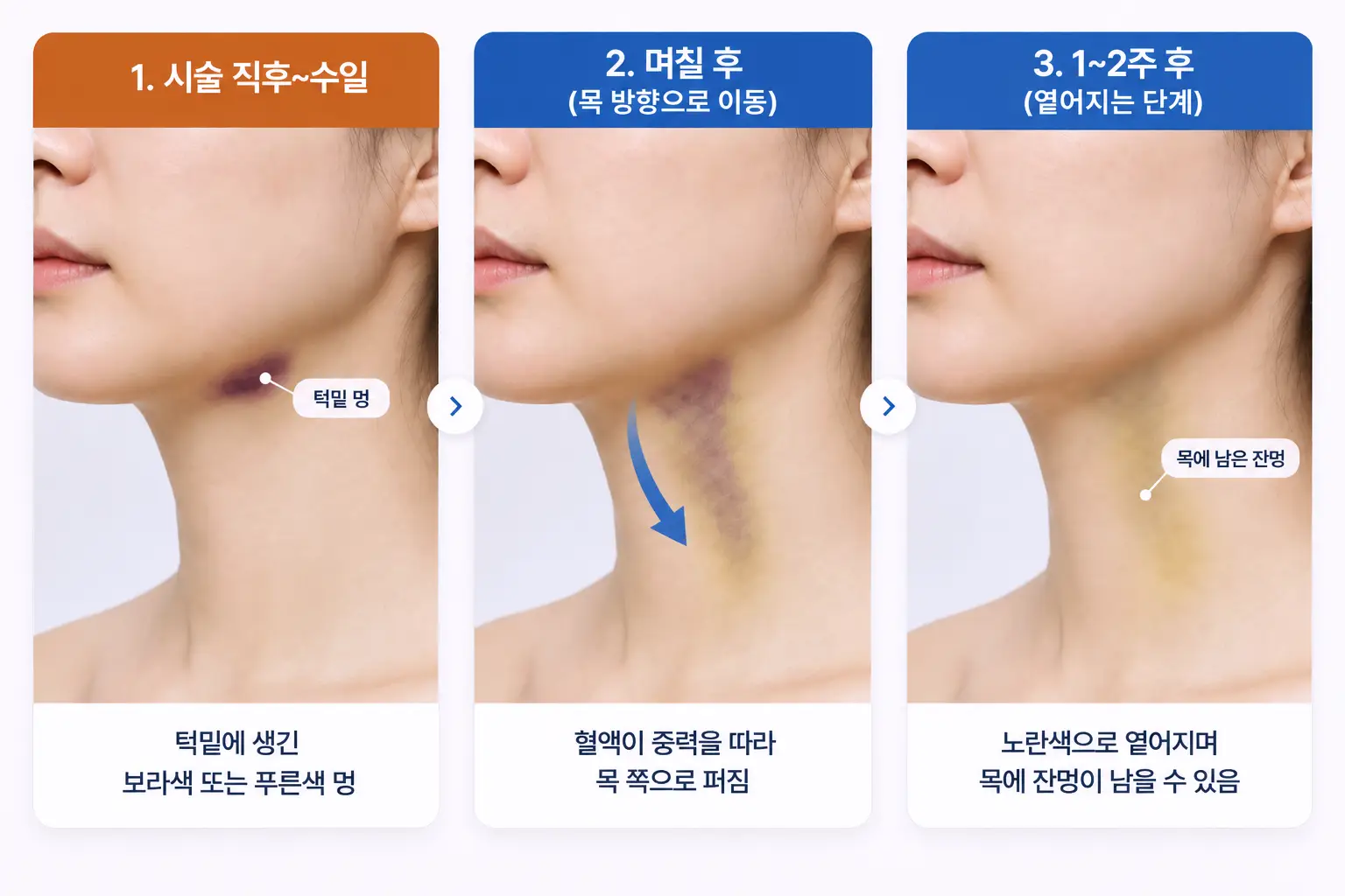 턱밑에 생긴 멍이 중력을 따라 목 방향으로 퍼지며 옅어지는 흐름을 측면 윤곽으로 보여준 비교 사진