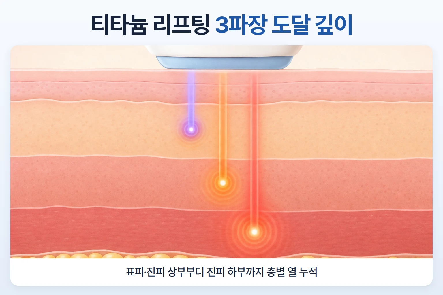 755·810·1064nm 세 파장이 표피부터 진피 하부까지 서로 다른 깊이로 닿는 피부 단면도