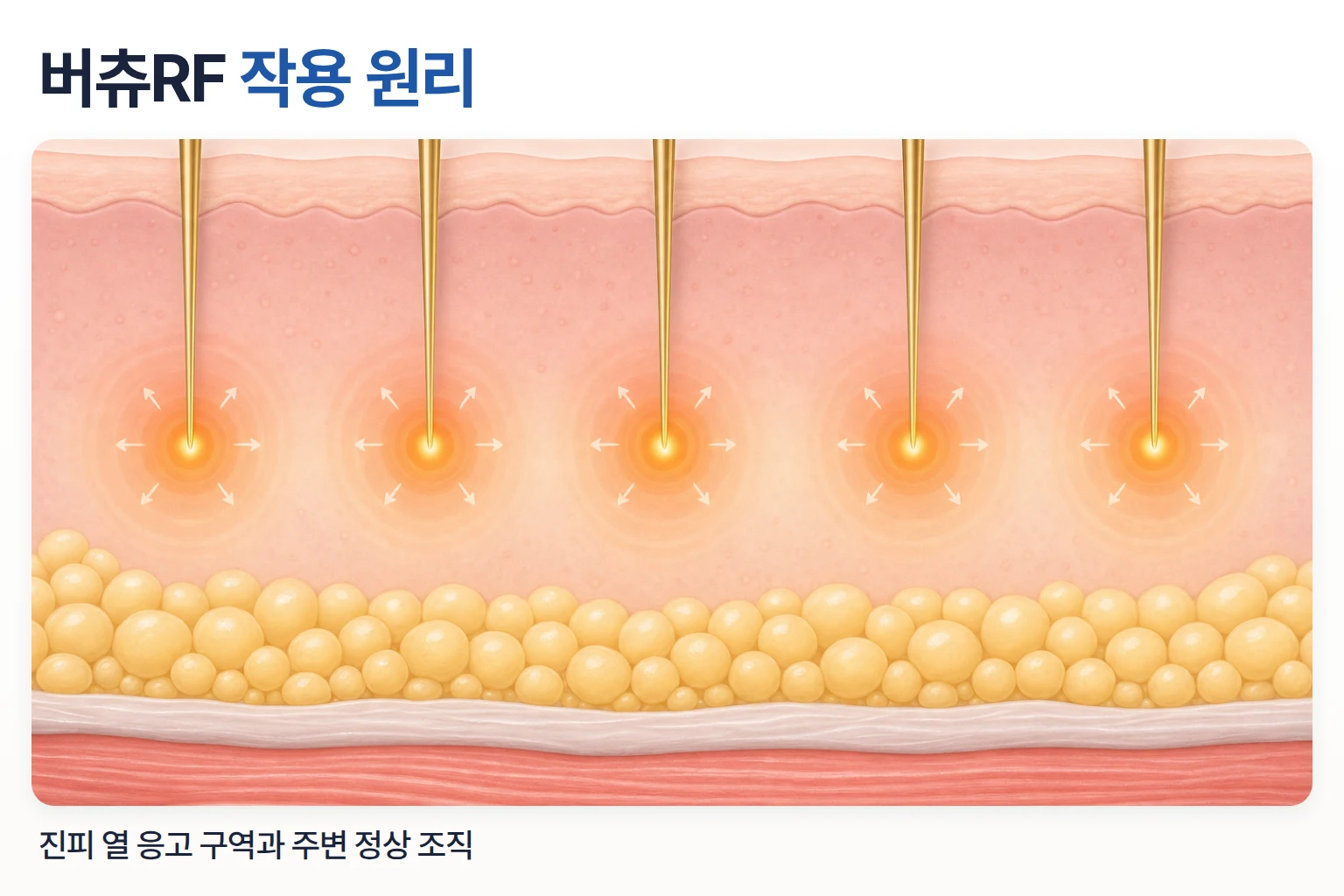 미세 니들이 진피에 삽입되어 바늘 끝에서 열이 퍼지는 과정을 나타낸 고주파 작용 단면도