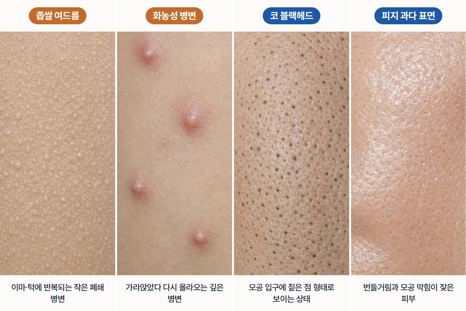 좁쌀 여드름, 화농성 여드름, 코 블랙헤드, 피지 과다 피부 표면을 동일 배율로 비교한 사진