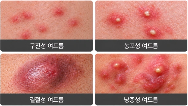구진성·농포성·결절성·낭종성 여드름의 병변 형태 비교 사진