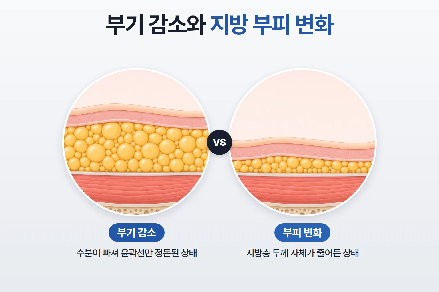 윤곽주사 후 부기가 빠진 상태와 지방층 두께가 줄어든 상태를 같은 배율로 비교한 턱선 단면도