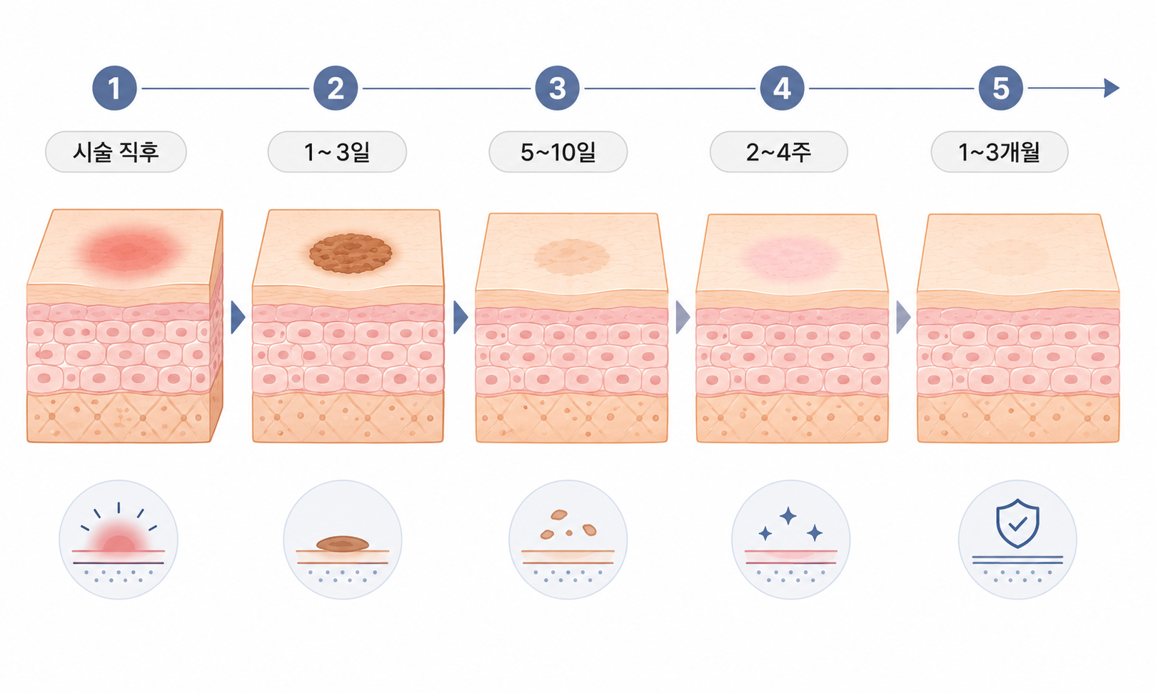 흑자 레이저 후 붉은기와 딱지 형성부터 탈락과 피부 안정화까지의 단계별 회복 과정