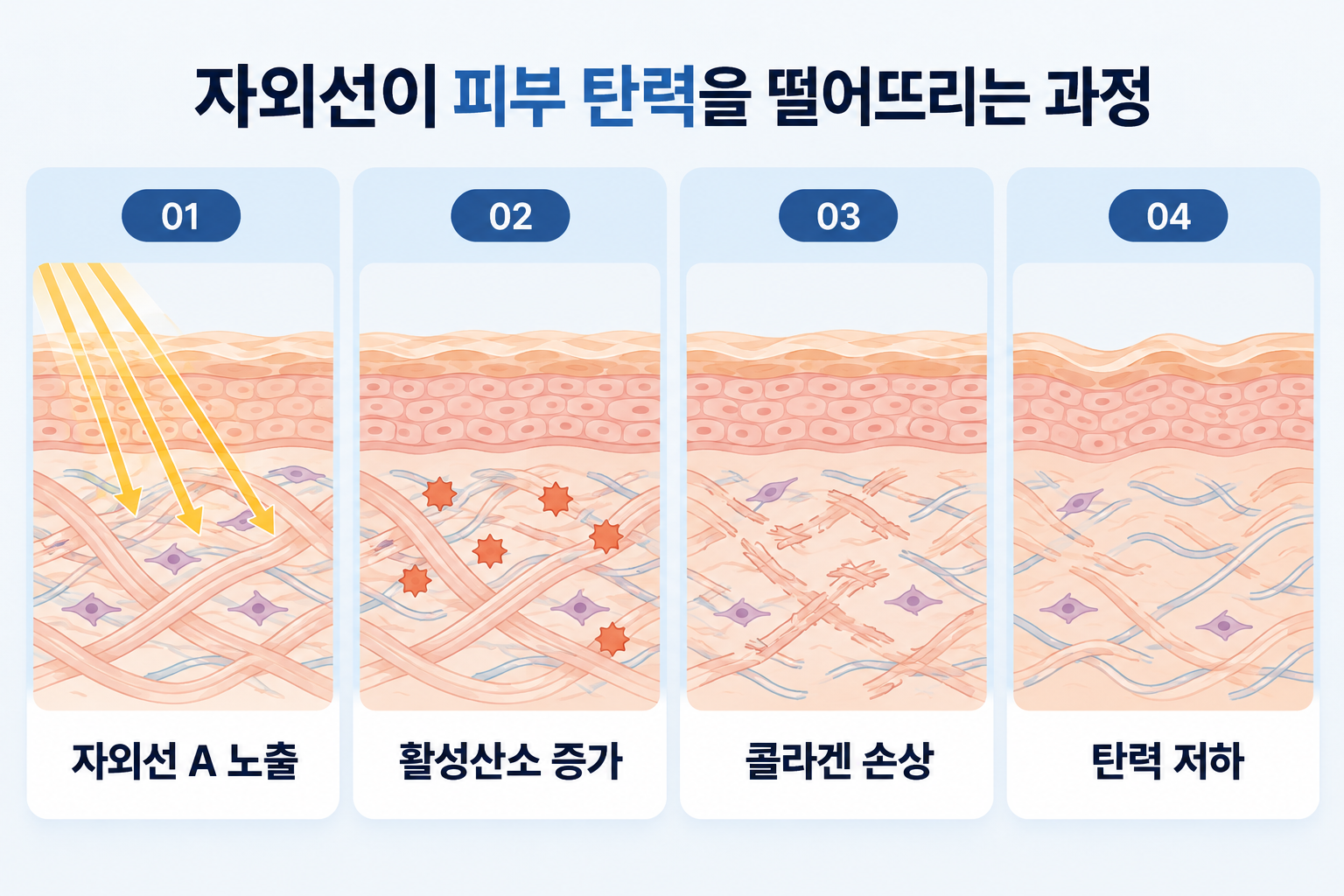 자외선 A 노출로 활성산소가 증가하고 콜라겐이 손상되어 피부 탄력이 저하되는 과정을 나타낸 피부 단면도