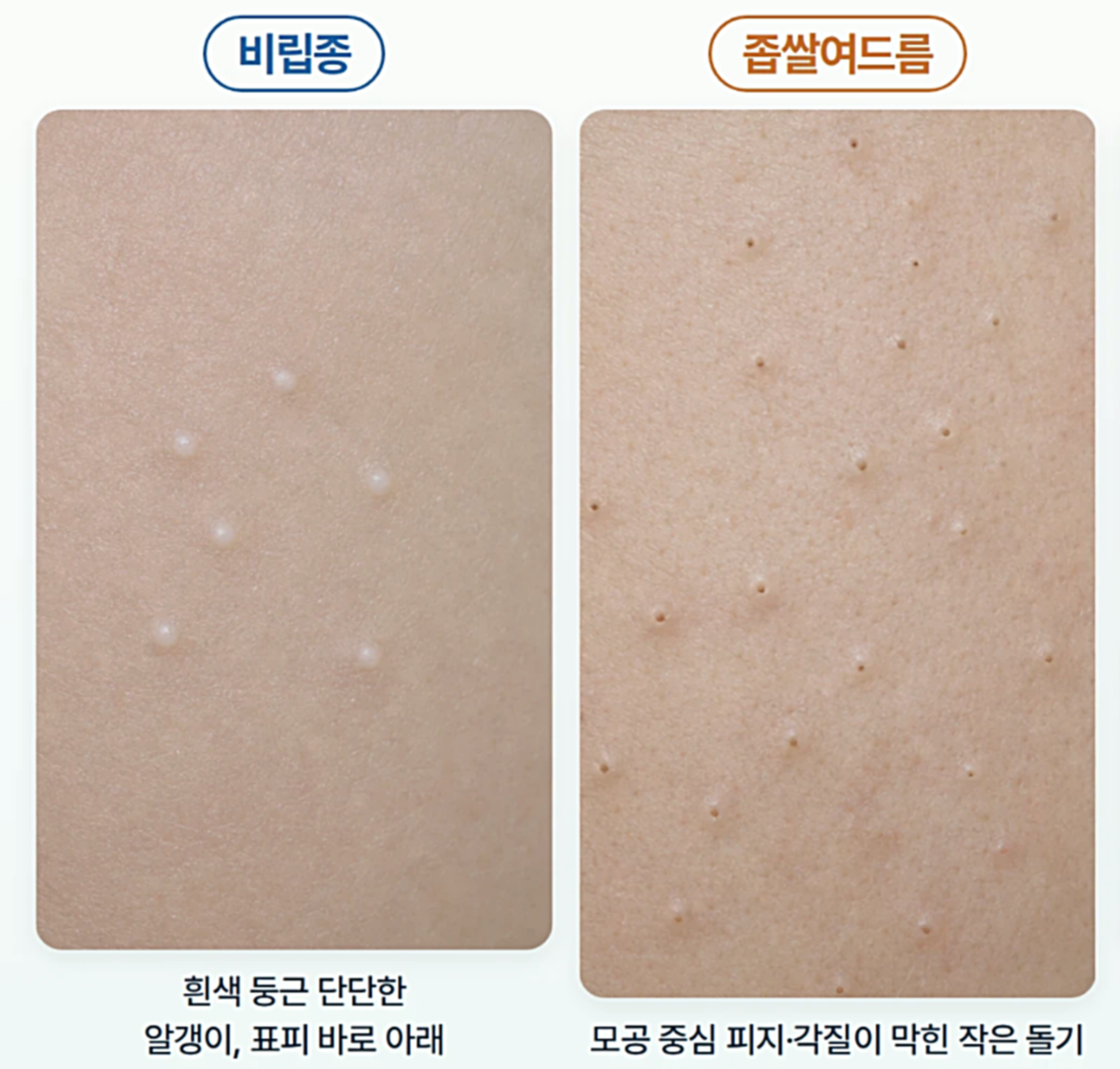 둥근 비립종, 모공 중심 좁쌀여드름을 동일 배율로 나란히 놓은 피부 비교 사진