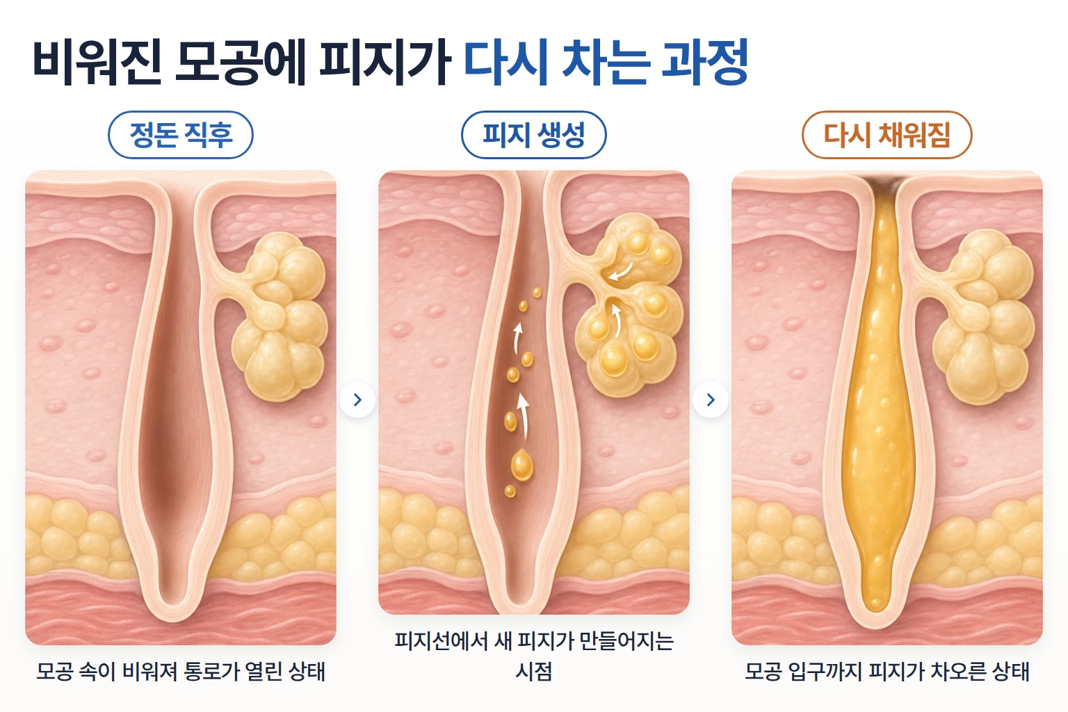 비워진 모공에 피지선이 새 피지를 다시 채우는 과정을 단계별로 비교한 개념도 일러스트
