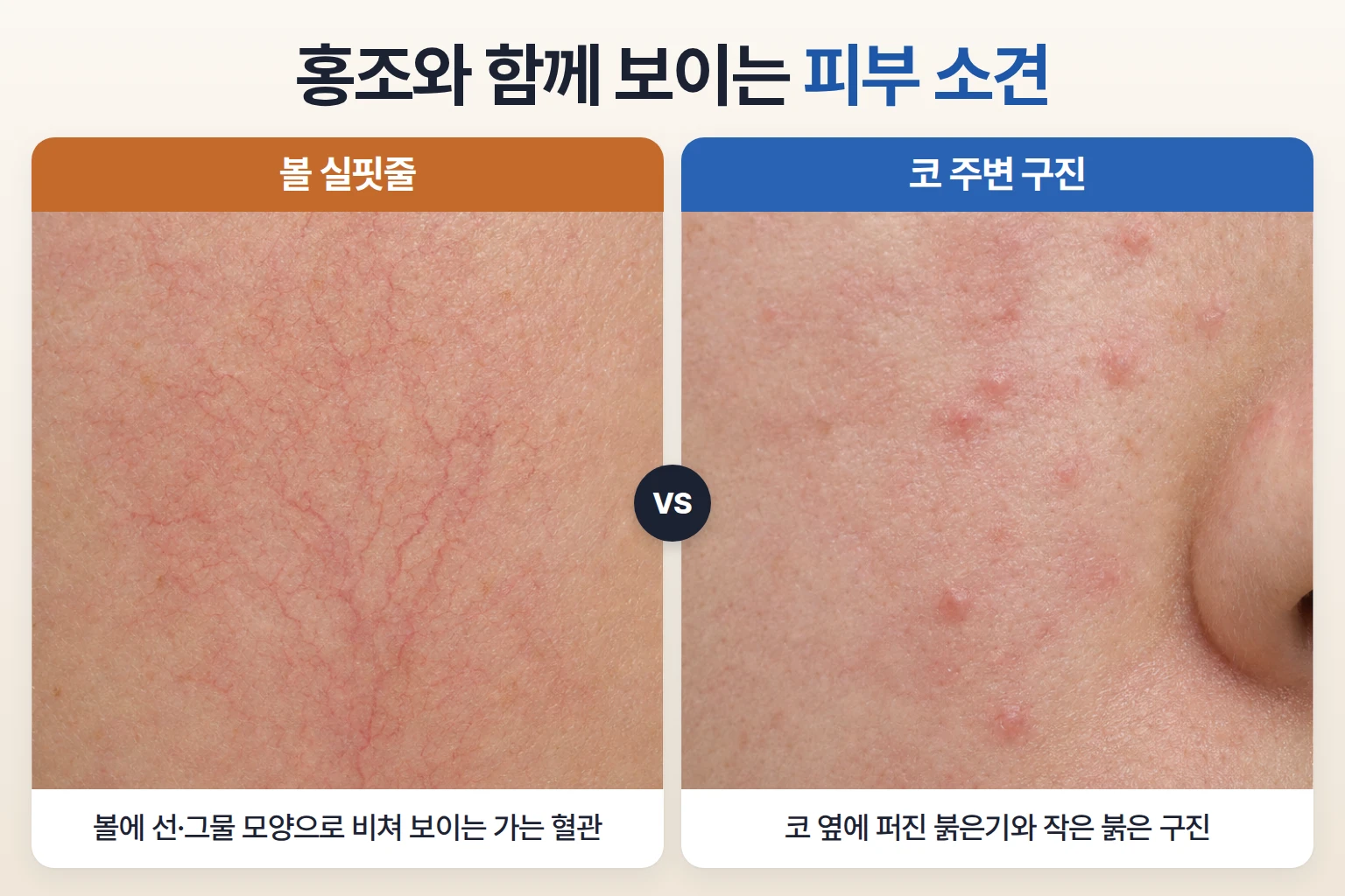 볼에 비치는 가는 실핏줄과 코 주변 붉은 구진을 같은 배율로 비교한 홍조 피부 확대 비교 사진