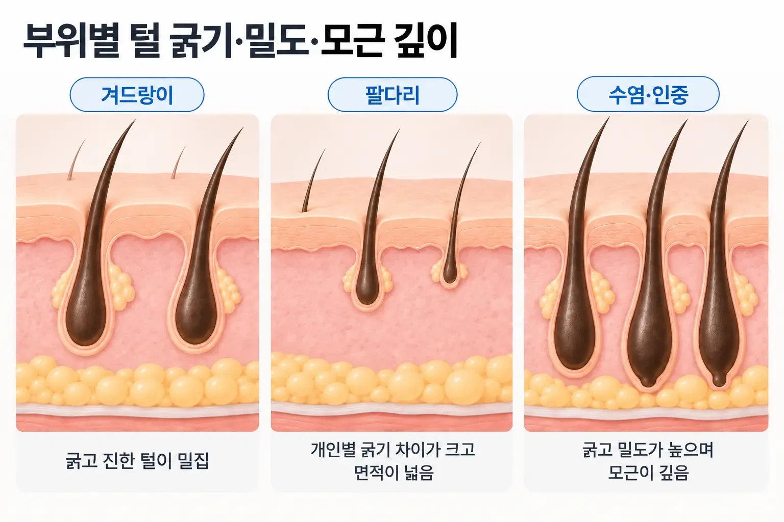 겨드랑이, 팔다리, 수염 부위의 털 굵기와 밀도, 모근 깊이를 같은 축척으로 비교한 단면 모식도
