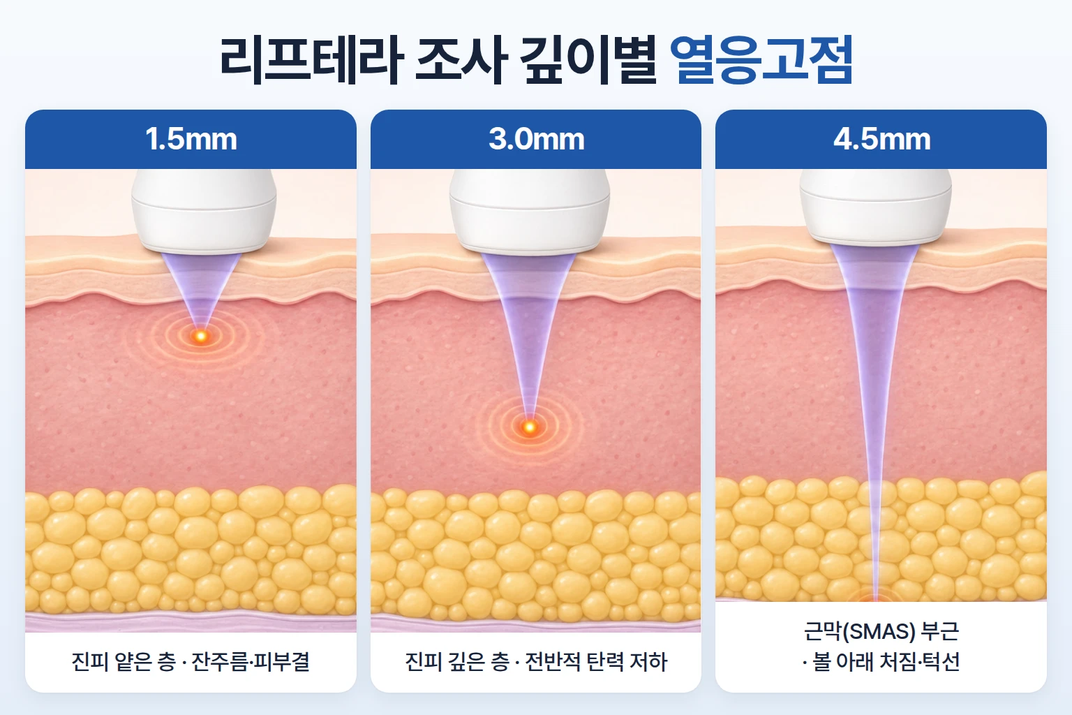 1.5mm·3.0mm·4.5mm 조사 깊이에 따라 달라지는 초음파 열응고점 위치
