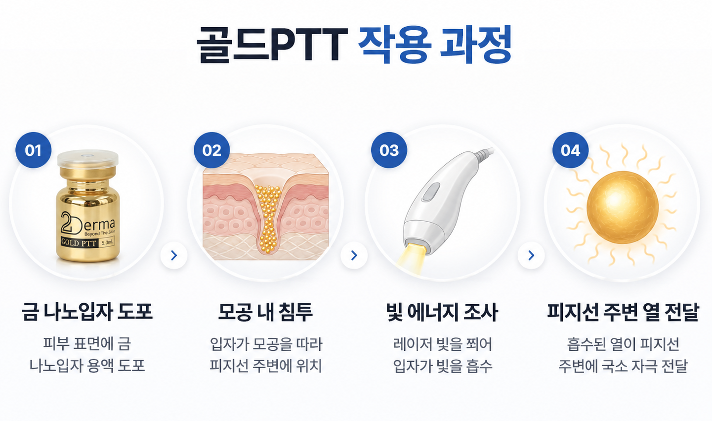 골드PTT 금 나노입자를 피부에 도포한 뒤 모공과 피지선 주변으로 전달하고 빛 에너지로 국소적인 열을 발생시키는 여드름 치료 과정