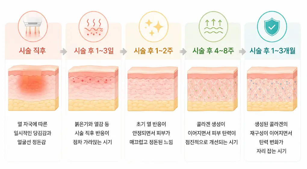 시술 직후부터 콜라겐 재구성까지 시기별로 나타나는 티타늄리프팅 효과