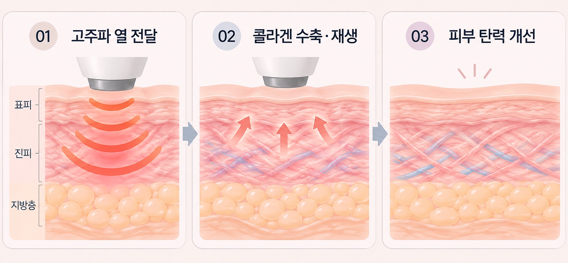 덴서티 고주파 열 전달과 콜라겐 수축 재생 과정
