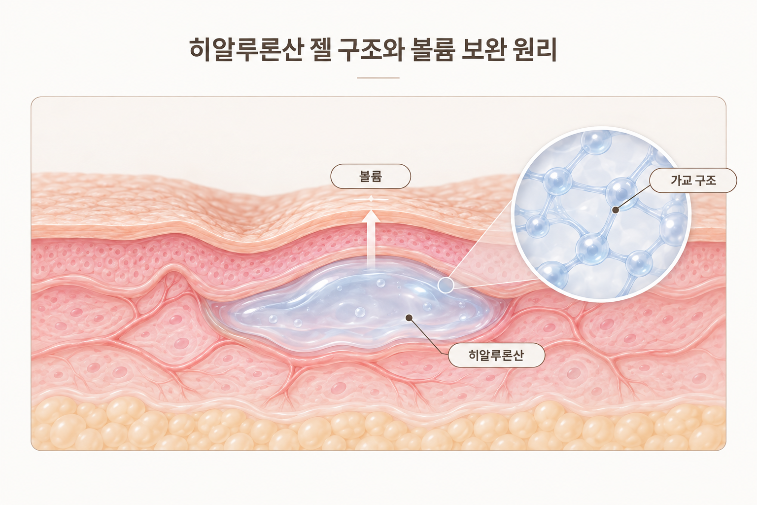 쥬비덤 필러 히알루론산 가교 구조와 볼륨 보완 원리