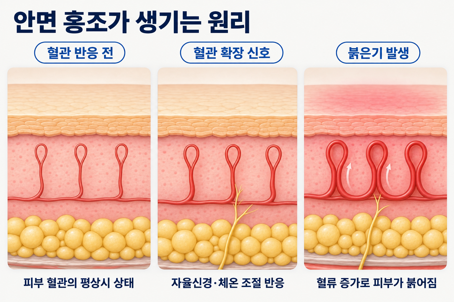 피부 혈관의 확장과 혈류 증가로 안면홍조가 발생하는 원리를 나타낸 피부 단면도