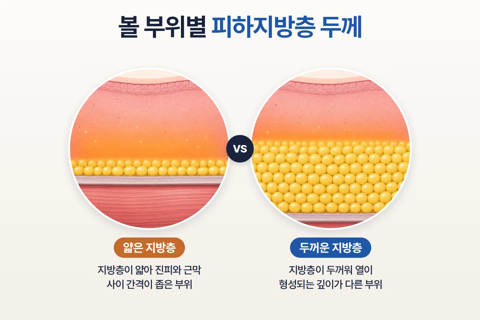 볼살이 적은 부위와 많은 부위의 피하지방층 두께 및 피부 단면 차이