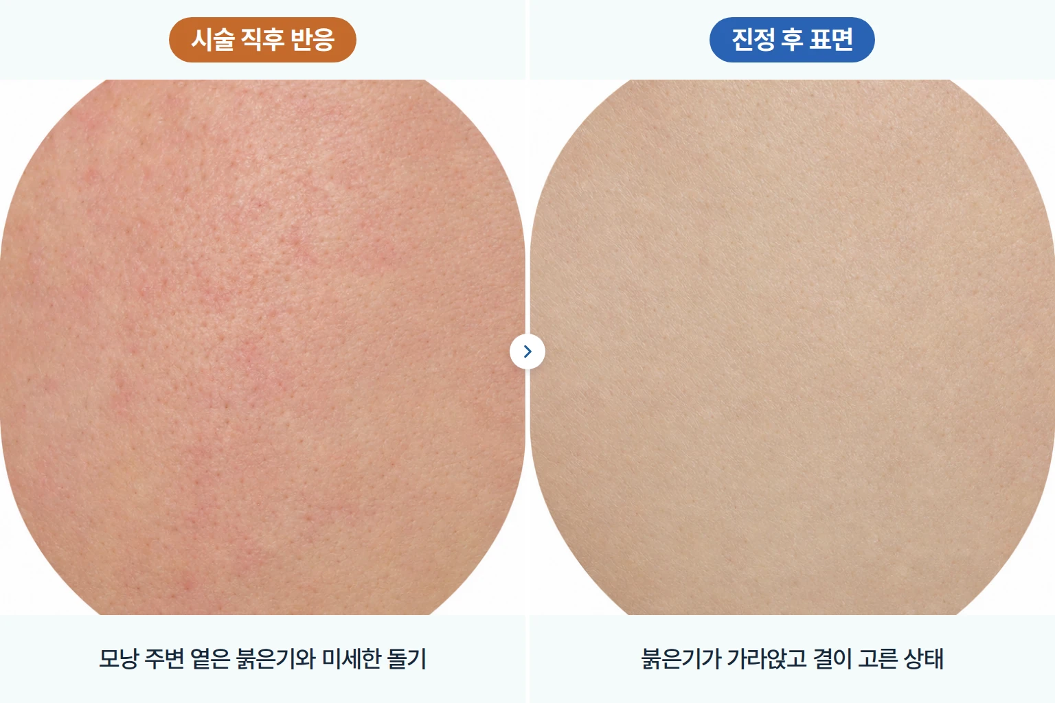 레이저 시술 후 모낭 주변 붉은기와 진정된 피부 표면을 같은 배율로 비교한 피부 확대 사진