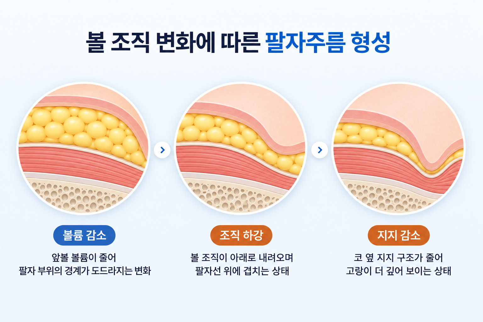 볼륨 감소와 조직 하강, 지지 구조 감소에 따른 팔자주름 형성 과정