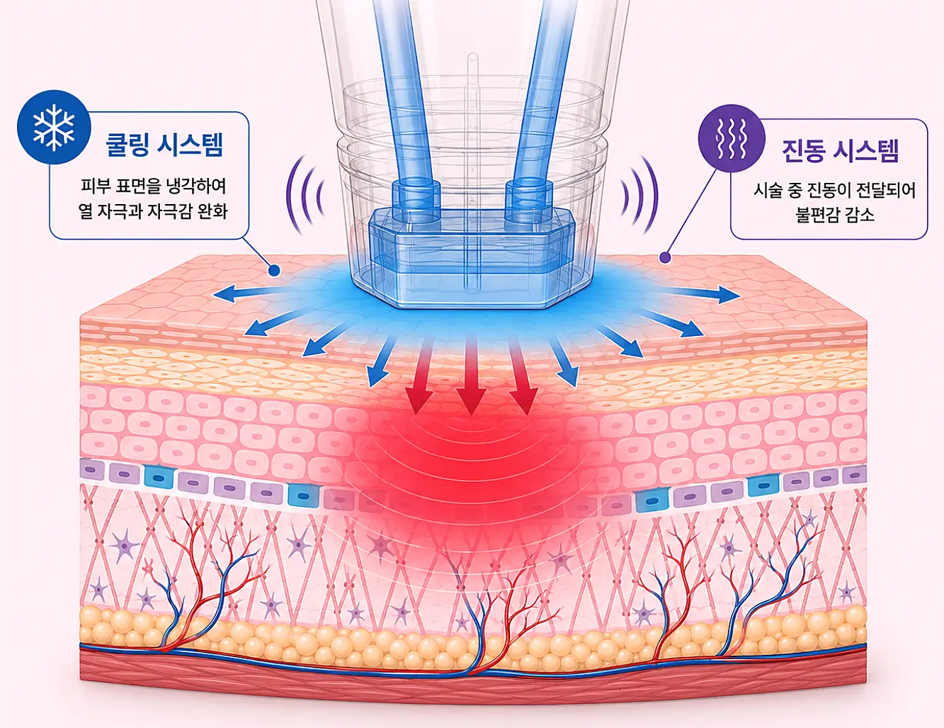 볼뉴머의 지속적인 수랭식 쿨링 시스템과 진동 시스템 원리