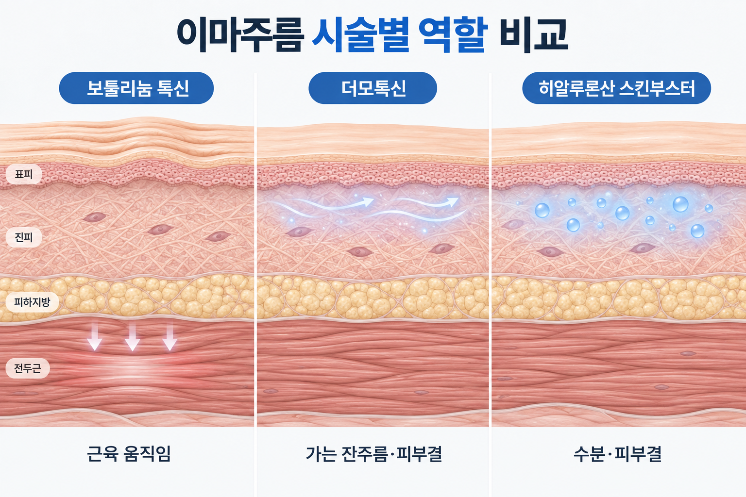 보툴리눔 톡신 더모톡신 히알루론산 스킨부스터의 이마주름 개선 역할 비교