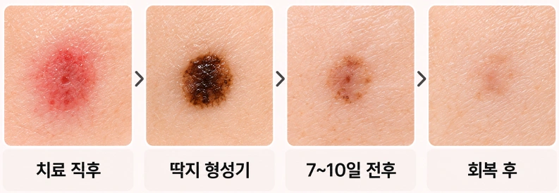 검버섯 레이저 치료 직후 붉은기부터 딱지 형성, 7~10일 전후, 회복 후까지 피부 변화를 순서대로 보여주는 회복 과정 비교 사진