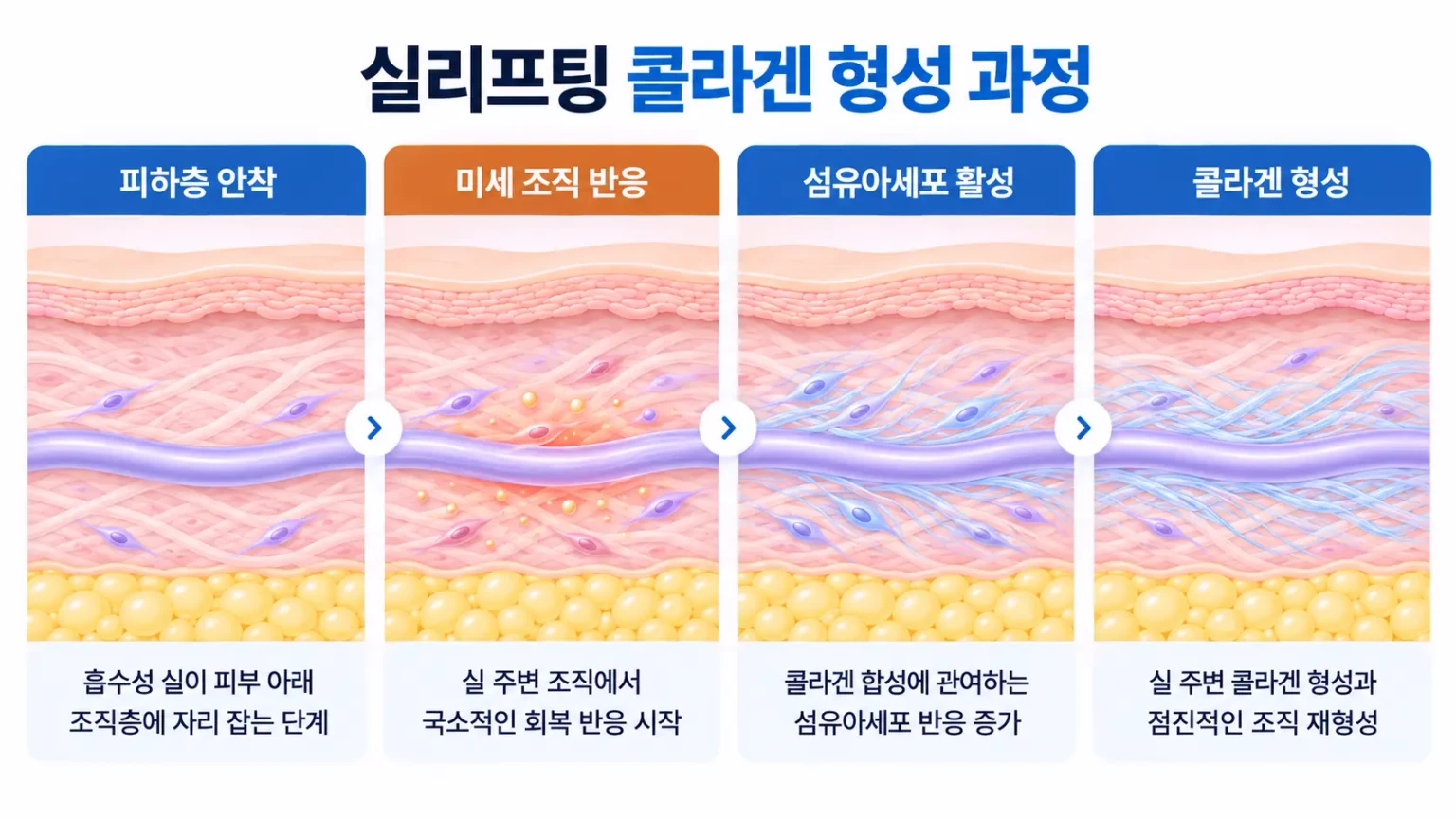 흡수성 실 주변의 미세 조직 반응, 섬유아세포 활성, 콜라겐 섬유 형성을 단계별로 나타낸 개념도