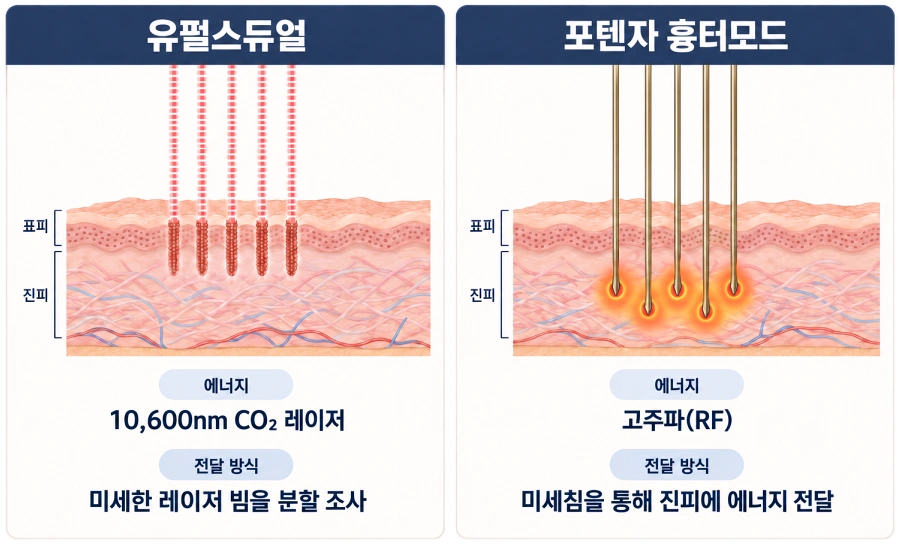 유펄스듀얼의 10,600nm CO₂ 레이저 분할 조사 방식과 포텐자 흉터모드의 미세침 고주파 RF 전달 방식을 피부 단면도로 비교한 여드름흉터 치료 원리 이미지