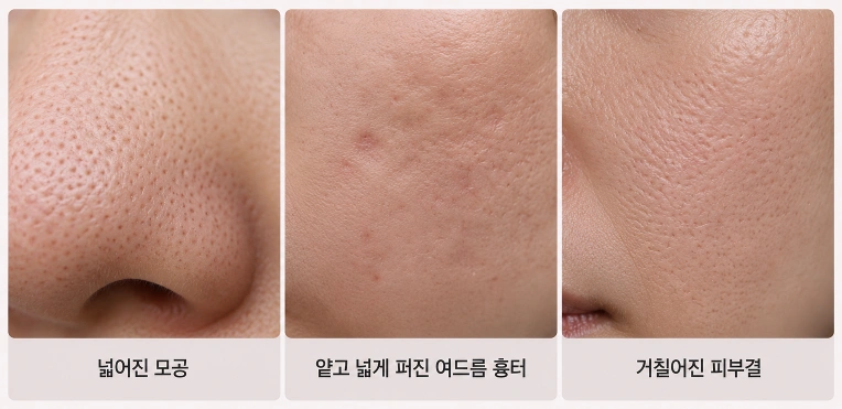 피코프락셀 효과를 기대할 수 있는 피부 유형