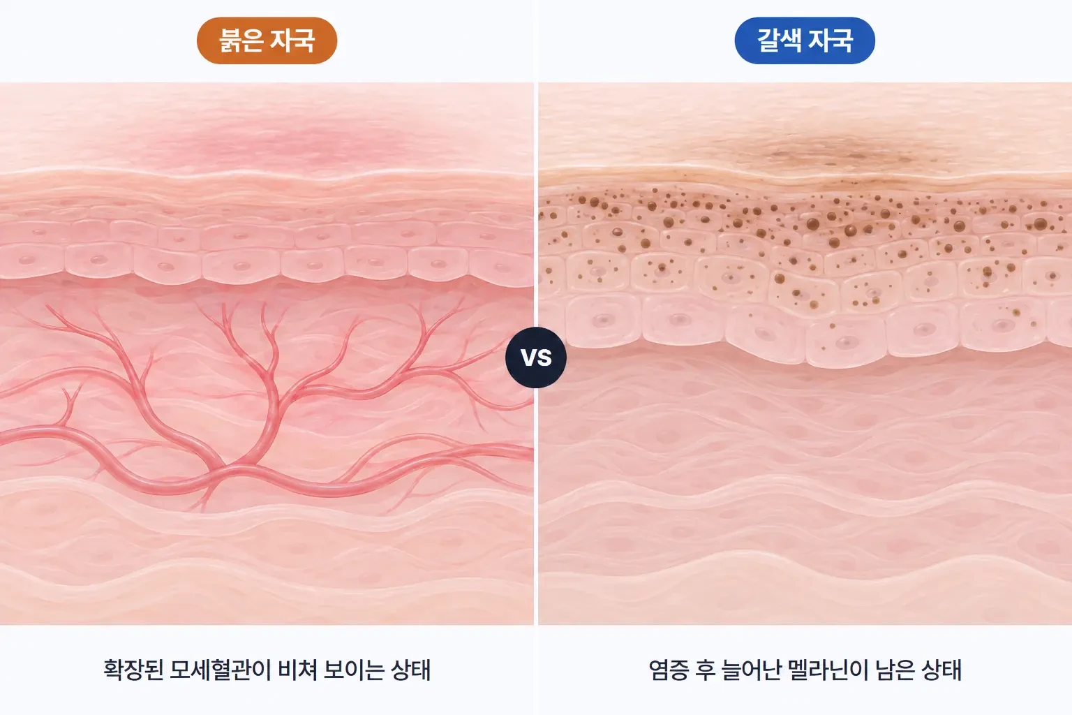 붉은 자국의 확장된 모세혈관과 갈색 자국의 멜라닌 분포를 나란히 비교한 확대 개념도